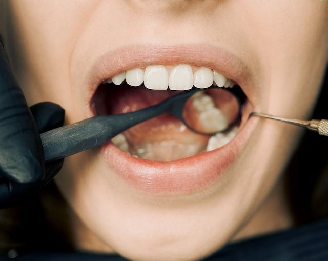 Tooth Extraction Services in Korea Town, Burnaby – Safe, Gentle, and Professional Care